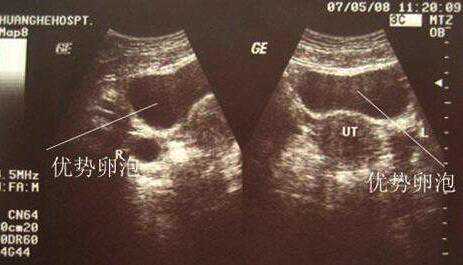 温州三代供卵试管婴儿 温州附一医生殖医学中心 ‘前期孕囊形状看男女’